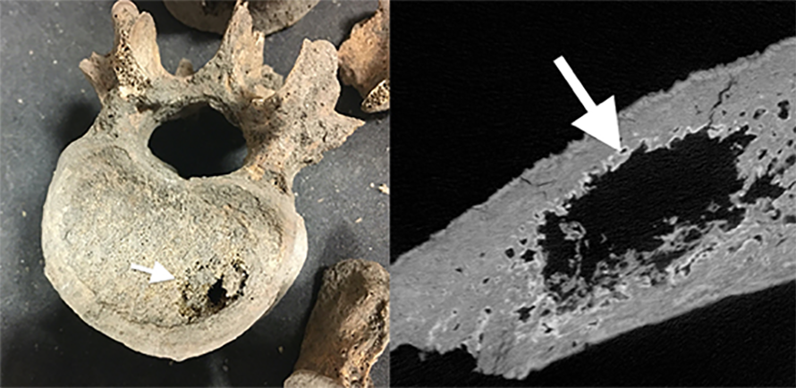 medieval cancer seen in human skeletal remains