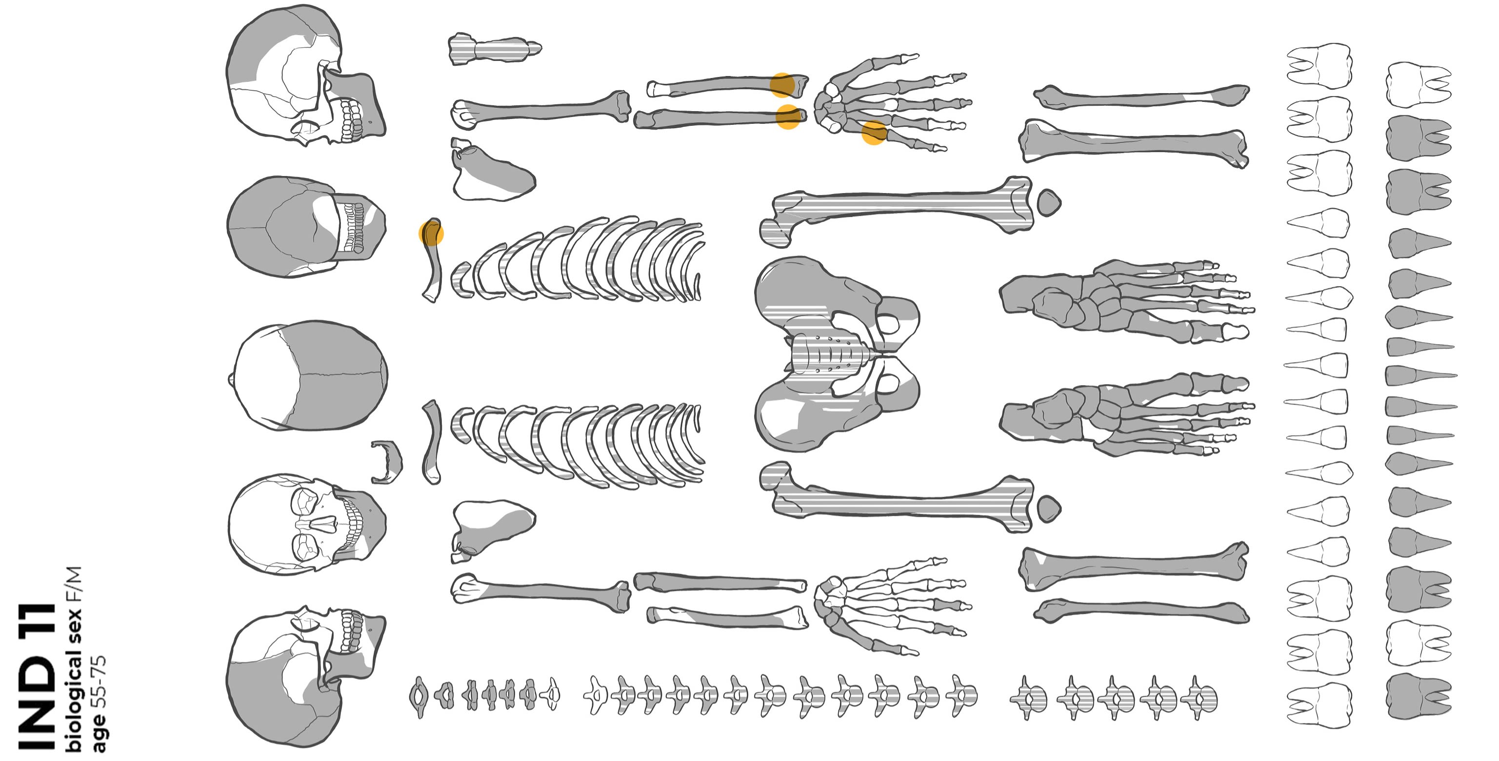 Overview of the state of preservation and location of the injuries of the six skeletons under study